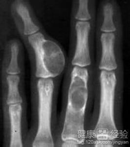 什么中医方能提高骨癌患者的体质