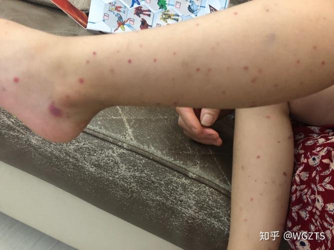 记录五岁小儿的过敏性紫癜治疗过程