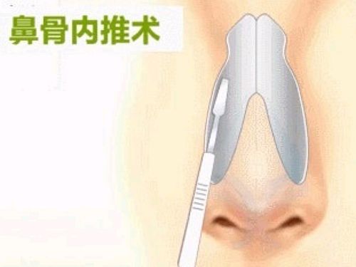 0269鼻骨内推可怕吗