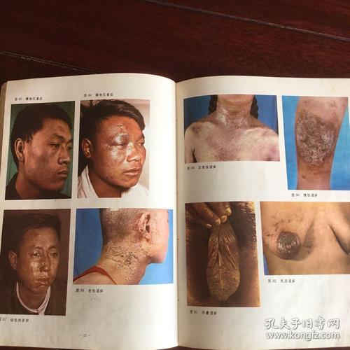 常见皮肤病彩色图谱 78年1版1印 插页47
