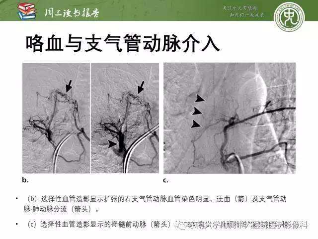 支气管动脉:解剖,功能及增粗和异常改变影像表现