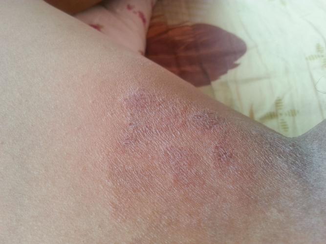 问:大腿根部有红斑,有点痒是怎么回事啊