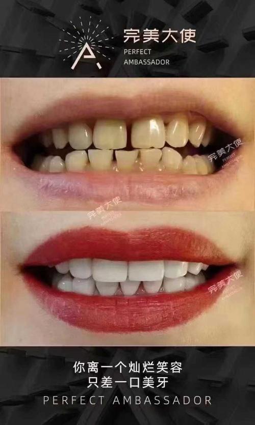 在不影响牙齿牙小管吸收代谢的根底上,起到维护牙齿并且美白美观的
