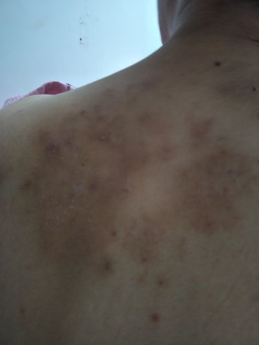 后背长的皮癣还是神经性皮炎?