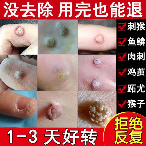 刺猴去除正品手部鱼鳞痣贴肉刺去除膏足部点祛猴子的药脚底去疣灵