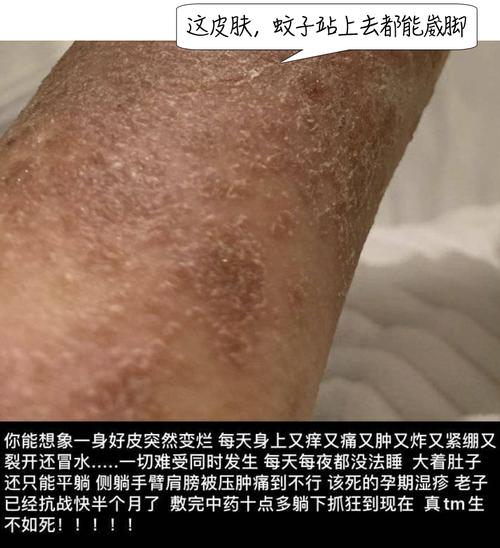 痒痒痒!每天都抠到流血,12岁女孩患上"不死的癌症"!