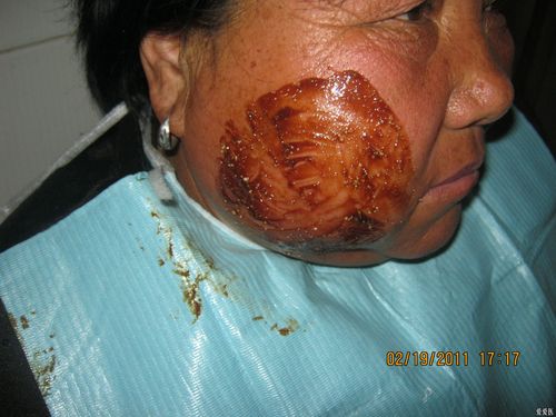 下颌下间隙感染病例一例