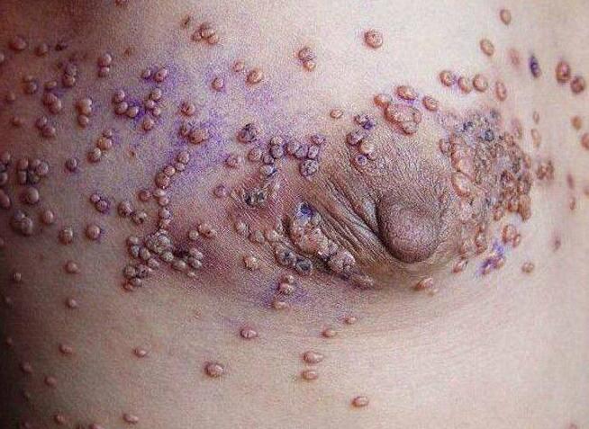 男人患艾滋病的初期症状有哪些 医院如何治疗艾滋病的