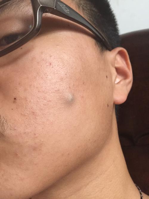 皮脂腺囊肿开刀切除可以用微创把伤口控制在很小的范围里