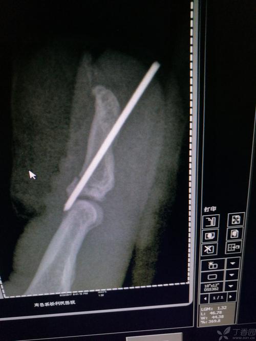 克氏针怎么取出来 取克氏针走医保