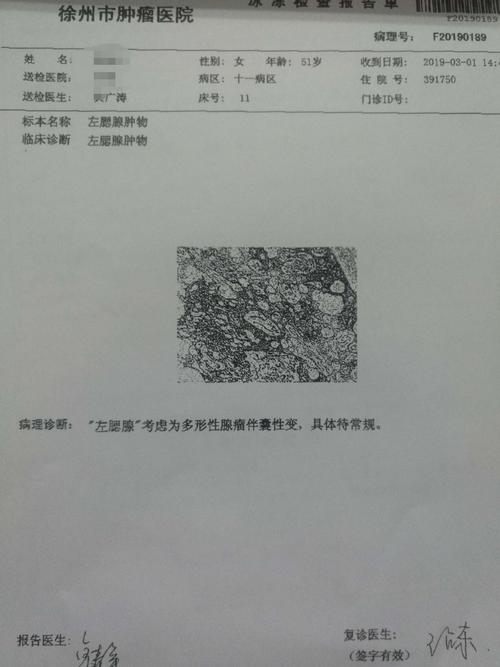 一例巨大腮腺混合瘤