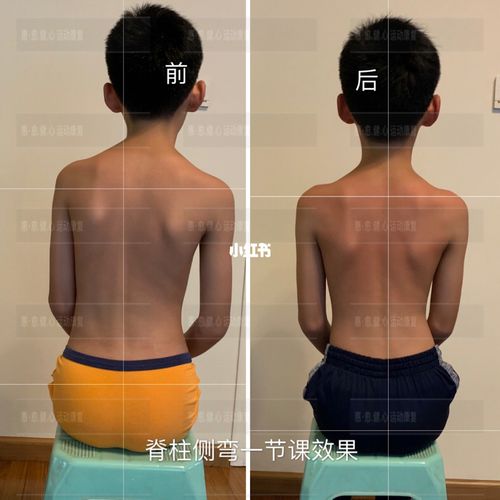 一次调整 建立正确的用力方式 改善脊柱侧弯,预防大于治疗