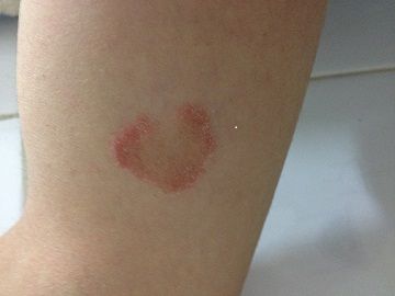 手臂起了一个类似环状的疱疹还是廯