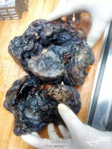 这是一个老烟枪的肺,看完你还吸烟吗?