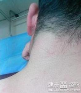 激光手术治疗脂肪.