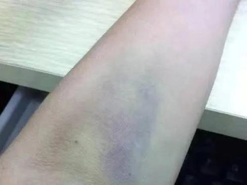 抽血后为什么手臂会青一块儿?是不是把血管扎坏了?