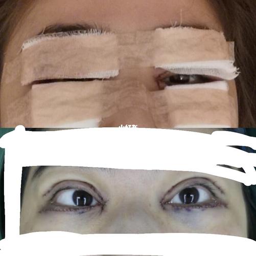 双眼皮开眼角 去眼袋提拉紧致 术后当天_开眼角_提拉紧致_双眼皮_去