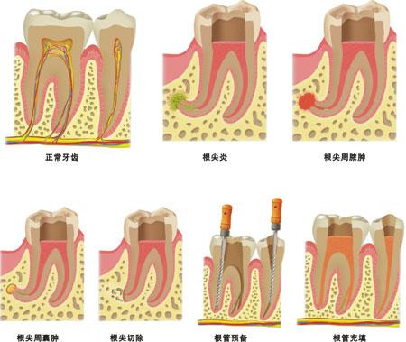 根管治疗是杀神经吗?什么是根管治疗?看牙疼吗?