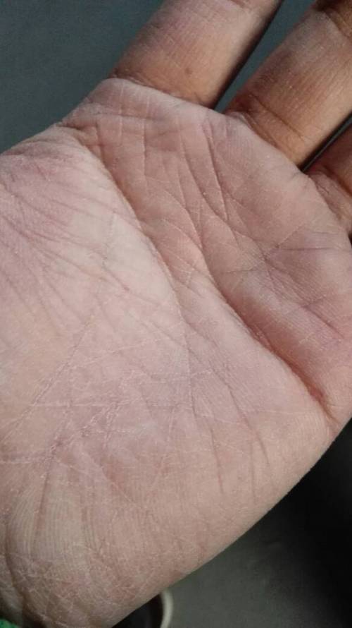 手掌干燥,怎么回事,远测在南方没有的,这几天到北京就出现这样的情况