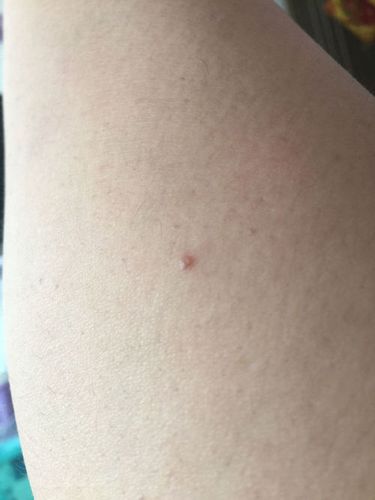 腿上有个小红点会不会是狗咬的,因为之前狗经过腿旁边