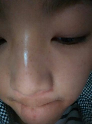 鼻子上有很多斑点,这个是什么呀?用什么方法可以尽快去除.求帮助.