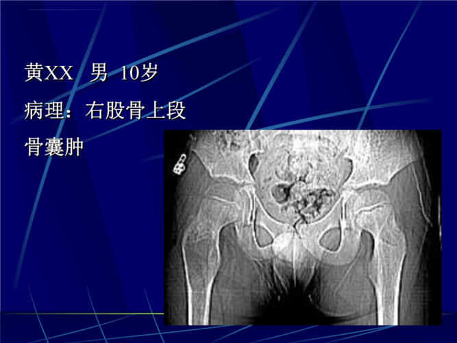 瘤样病变之(骨囊肿2)ppt课件.ppt