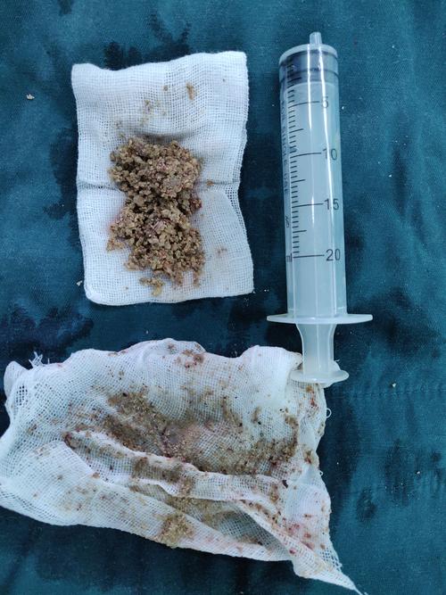 新城医院成功完成一例超声引导下经皮肾镜右肾巨大铸型结石碎石取石术