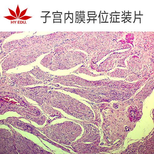 子宫内膜异位症生物切片人体病理切片显微镜配套生物切片