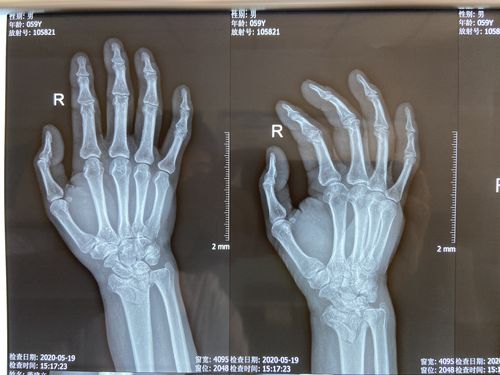 右侧桡骨远端骨折,舟骨骨折