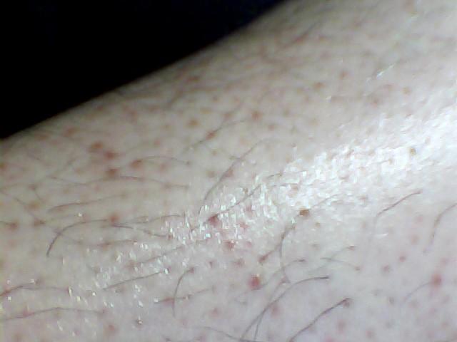 这是毛囊炎还是毛周角化?谢了.