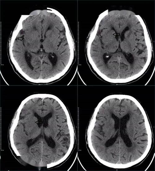 超急性期大面积脑梗死 ct 平扫表现