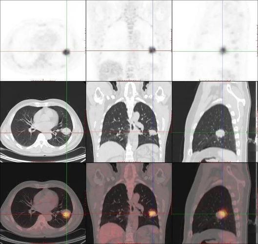 幸运的是,pet/ct图像显示该患者除肺部肿瘤除原发灶外,没有发现淋巴