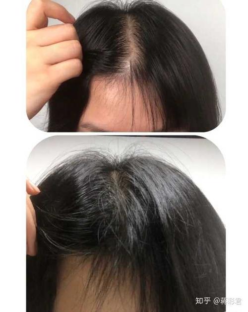 女性脂溢性脱发该怎么治疗?