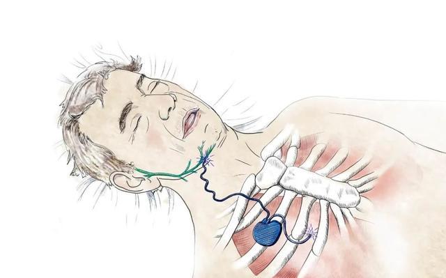 "睡眠呼吸暂停"是种什么病?