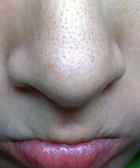 毛孔里反反复复挤出的小米粒,属于螨虫黑头,3个招数能帮你