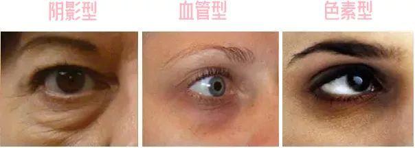 黑眼圈主要分为3种:阴影型,血管型和色素型.