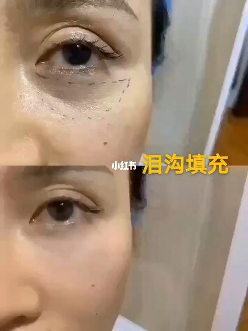 泪沟填充_泪沟_眼袋_眼袋泪沟_美妆_医美整形