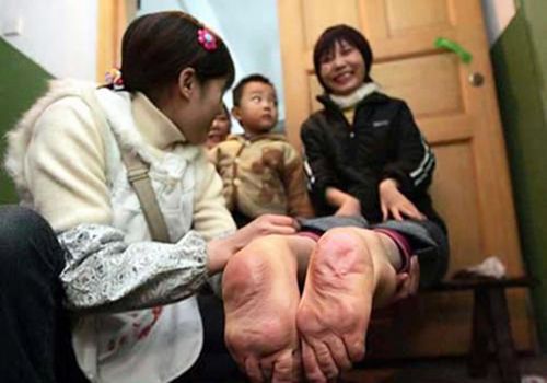 近亲结婚害惨下一代两个孩子都有缺陷女儿更是月月要过鬼门关