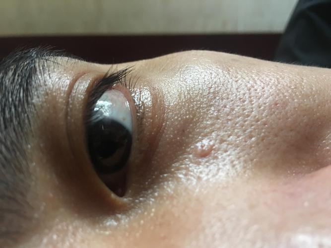 我眼睛下面长的这个好几年了,感觉现在变大了,好困扰!