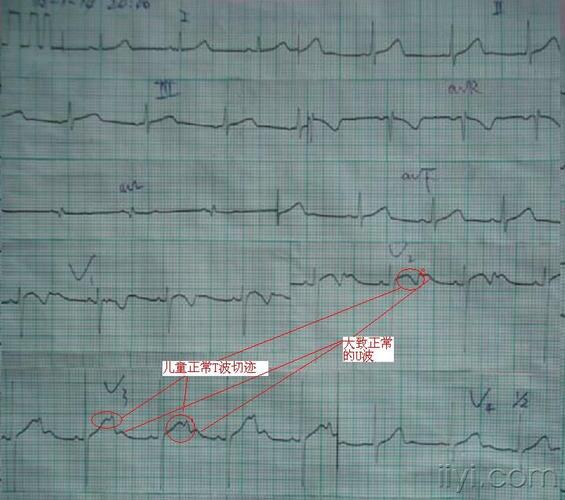 大家帮忙分析一下这份心电图   这个图主要是同房早二联律鉴别