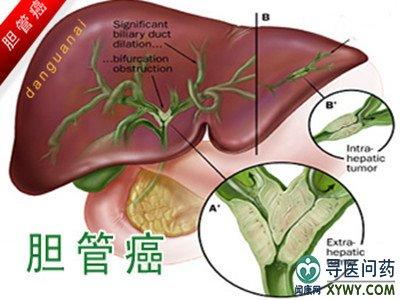 肿瘤科 胆管癌 胆管癌常识 病因学