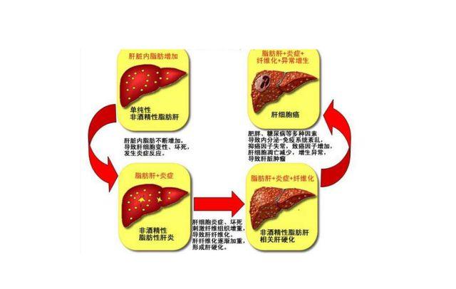 脂肪肝立即消失,必须经过4~5年才能消失,所以脂肪肝的治疗需要一个