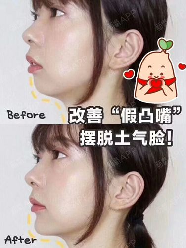 导致整个下颚线条非常不好看,骨性嘴突又不能单纯靠整牙解决,垫下巴又