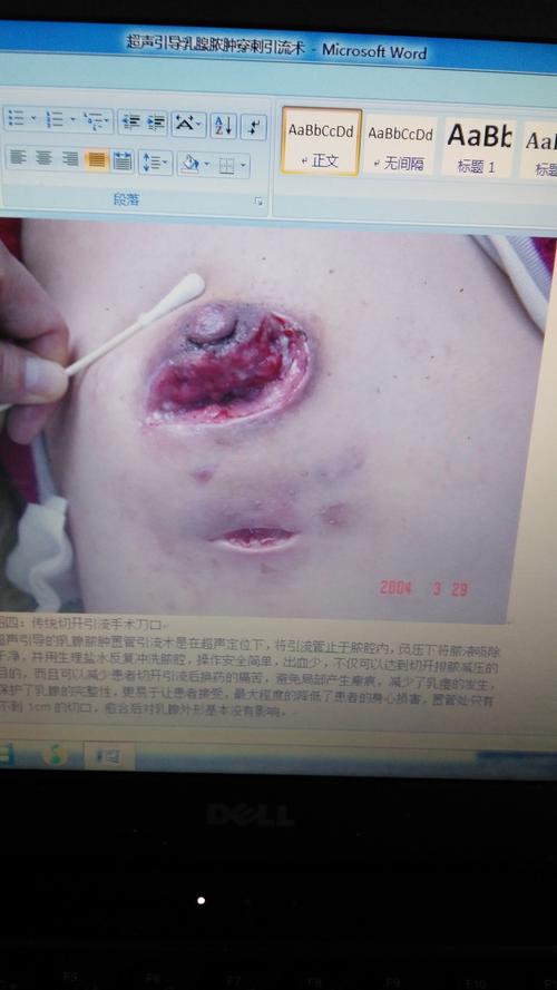 不开刀治疗乳腺脓肿!