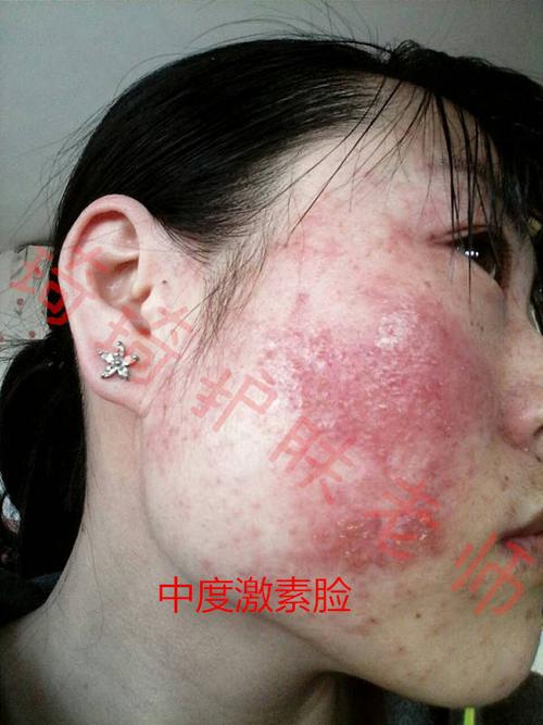 第二种,中度皮损:中度激素脸患者,基本上是全脸发红,肌肤屏障受损严重