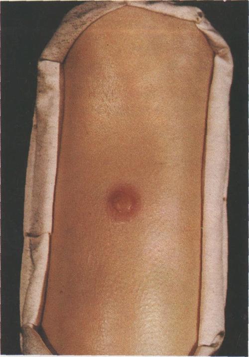 性病性淋巴肉芽肿