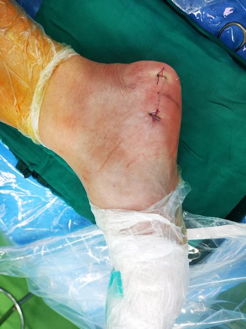 关节镜下切除跟骨骨刺治疗顽固性足跟痛