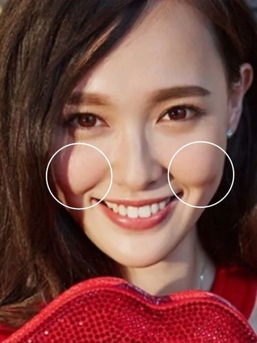 苹果肌96是越大越好吗71苹果肌下垂怎么办71.少