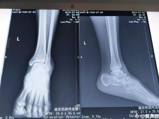 左跟骨粉碎性骨折