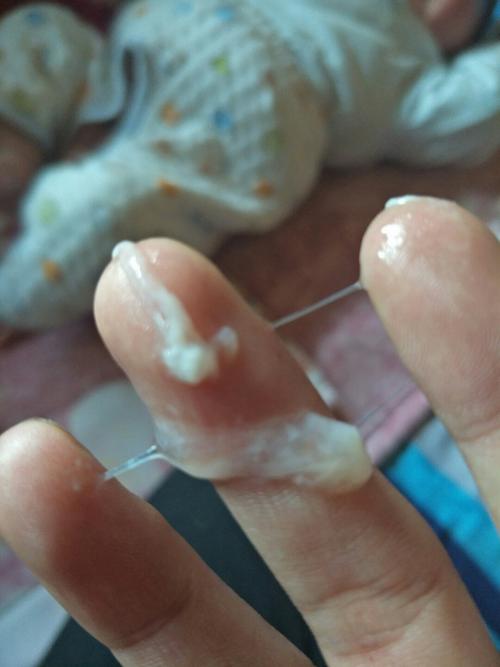 侧切伤口里面流这个